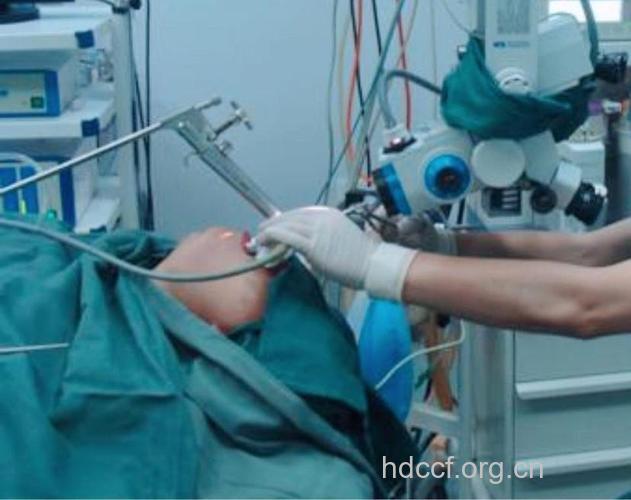 治声带息肉的手术治疗