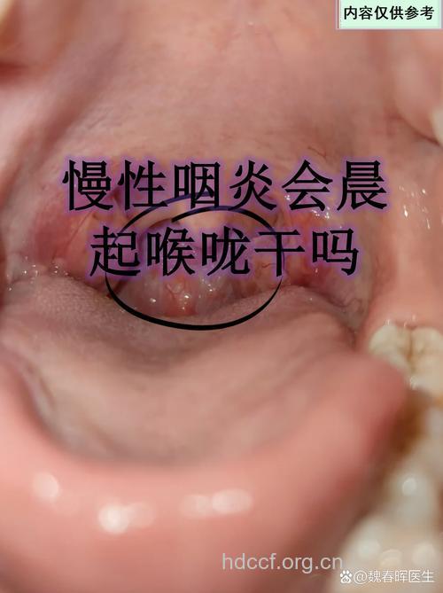 经常出现干呕或是慢性咽炎