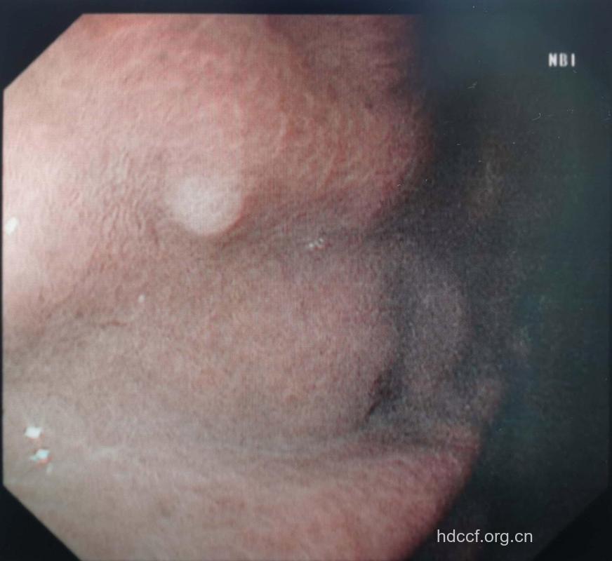 胃息肉早期的表现症状