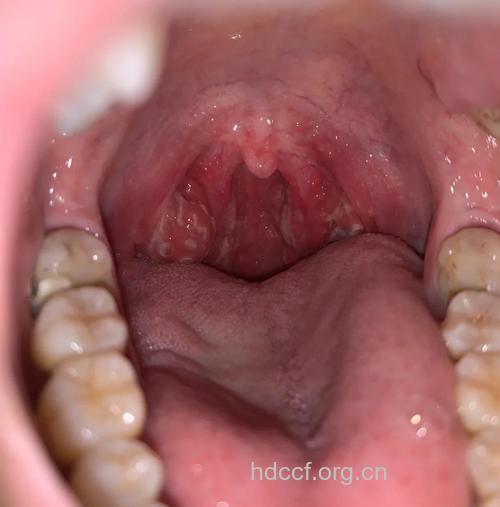 儿童扁桃体炎