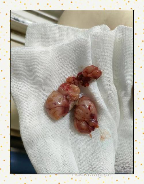 小朋友扁桃体切除需要慎重考虑