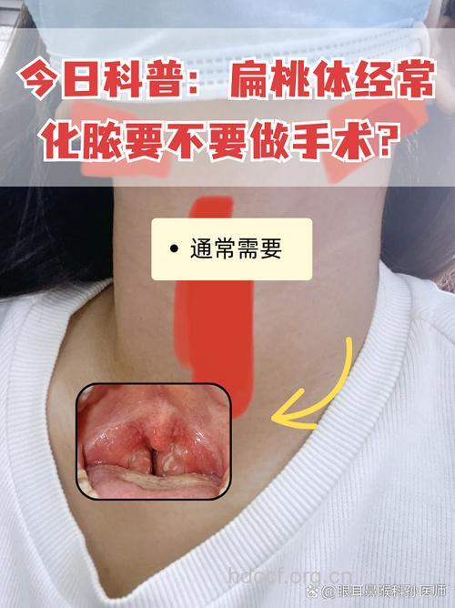 什么情况下扁桃体炎需要手术