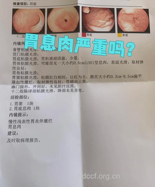 胃部炎症小心患胃息肉