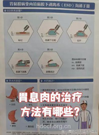 胃息肉如何有效治疗