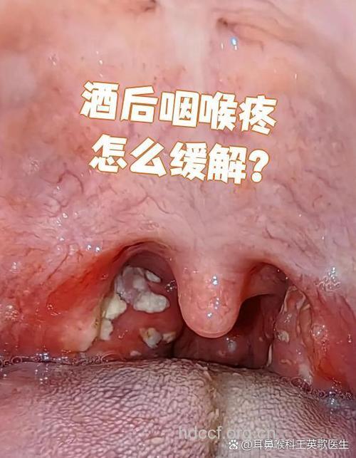酒后唱歌易伤喉