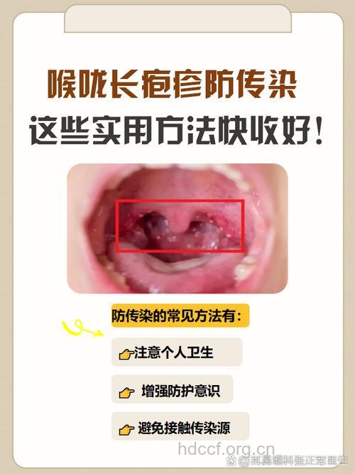怎么治疱疹性咽峡炎?