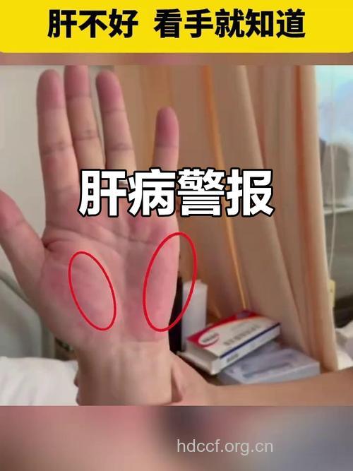 肝脏出现问题 手脚会有4个表现