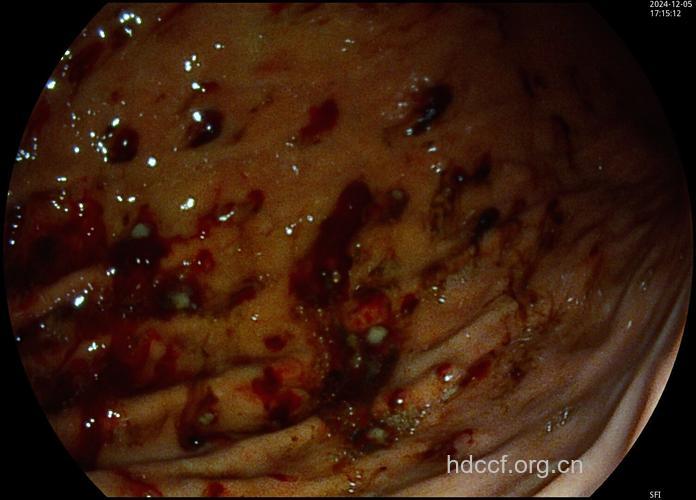 胃镜下胃息肉的“众生相”