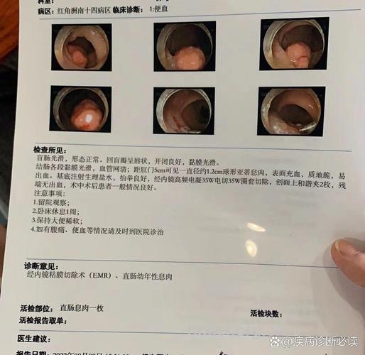 幼年性息肉病怎么办？