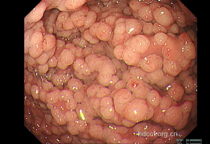 胃息肉中75%以上为增生性