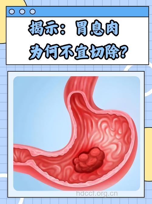 全面解析:您必知的胃息肉