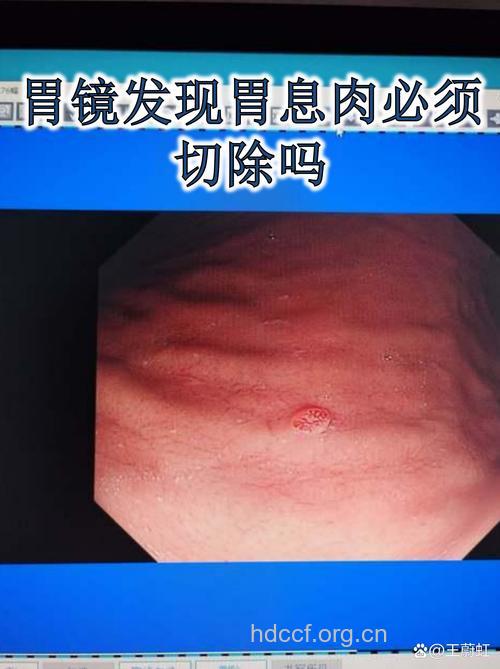 胃息肉是否应该及时切除？