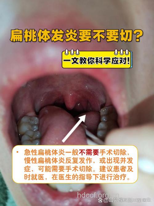 发炎就要切扁桃体吗？