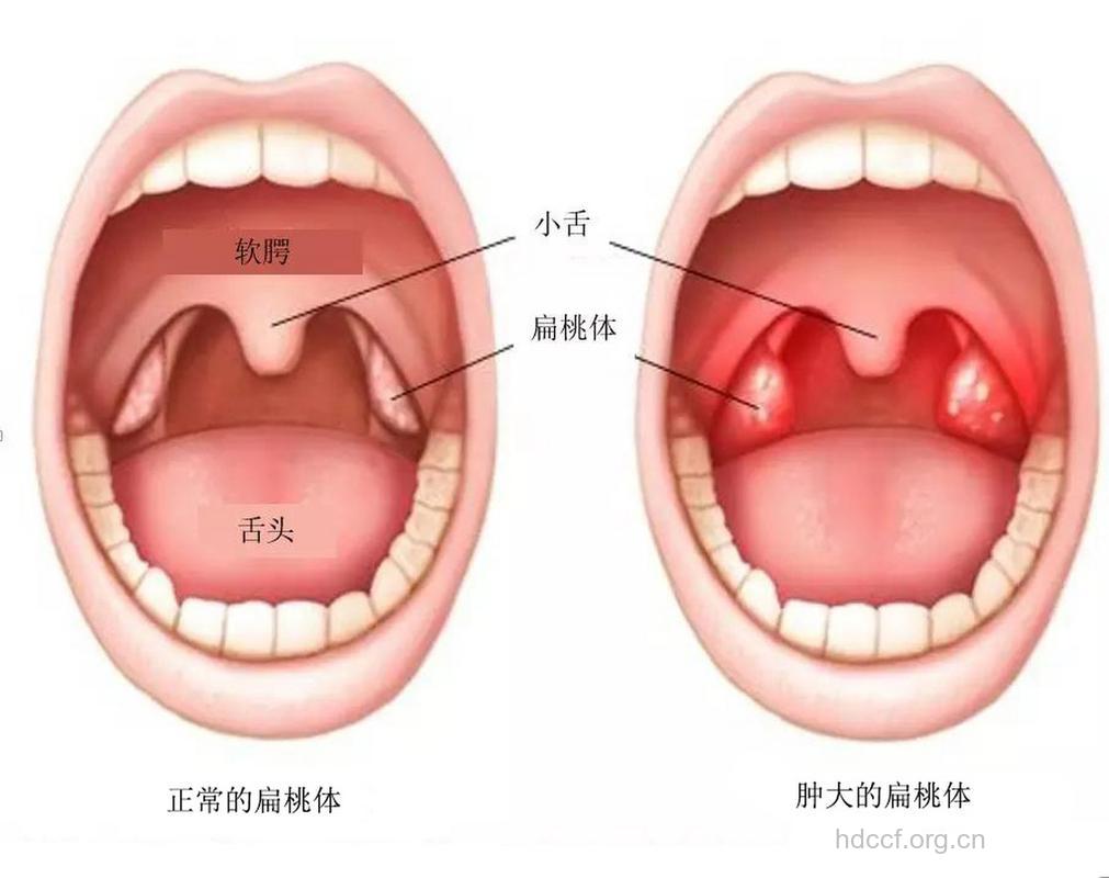 为何孩子的扁桃体如此脆弱?