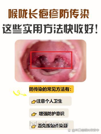 关于咽旁脓肿的诊断原则