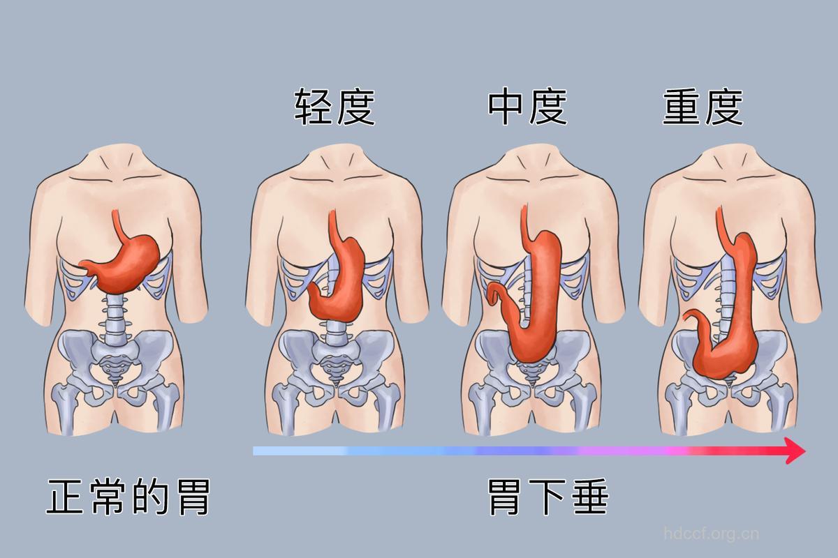 减肥不当会导致胃下垂