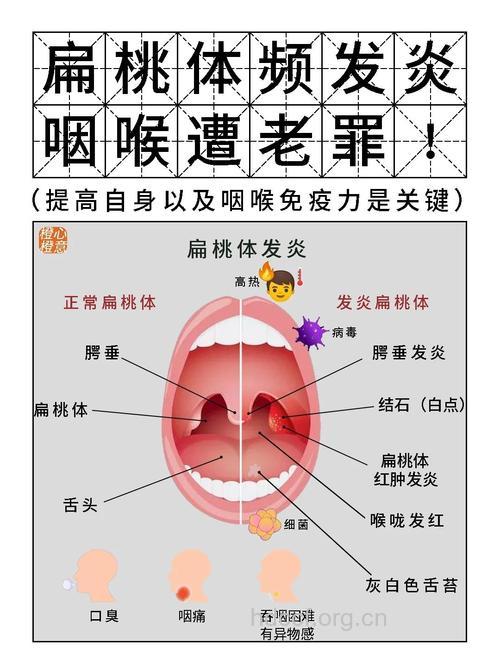 详解儿童扁桃体发炎