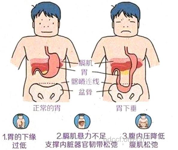 为何年轻人容易胃下垂