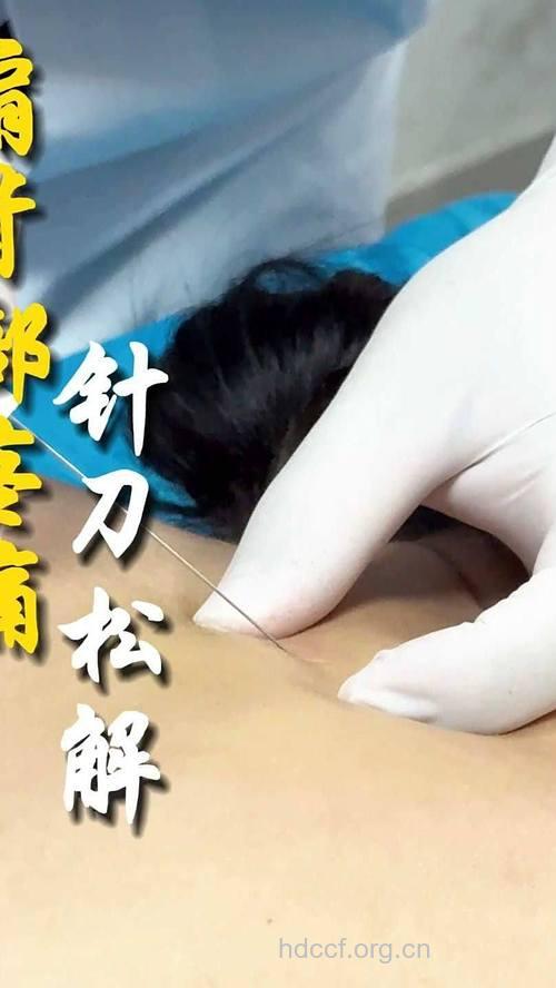 肩周炎新疗法--超短波并针刺疗法