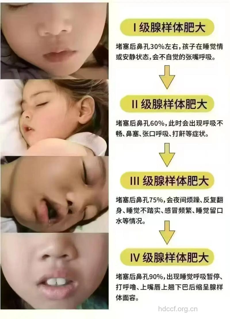孩子腺样体肥大不可小觑