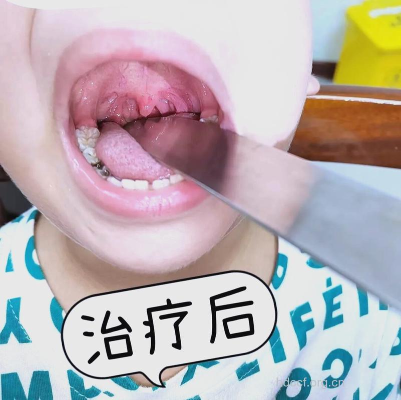 儿童扁桃体肥大中药疗法