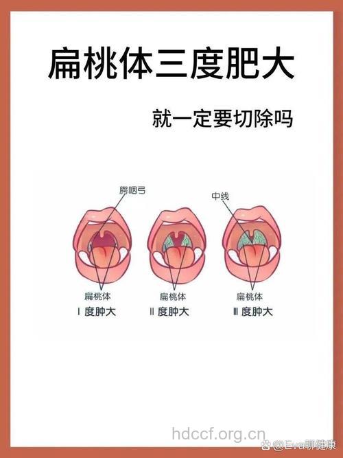 如何辨治咽扁桃体肥大?