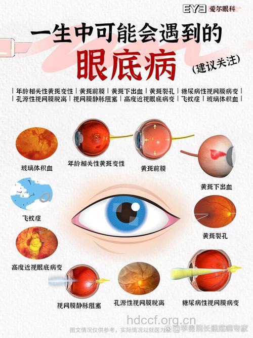 要当心 3种眼病容易引起眼底病