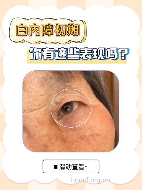 白内障早期有四种症状 如何判断是否患上