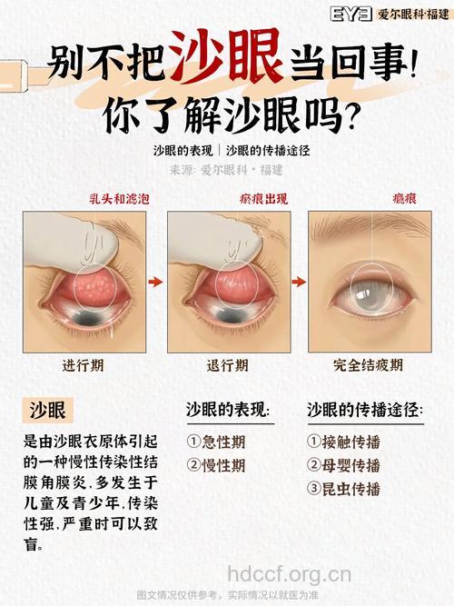 警惕 沙眼的五种并发症