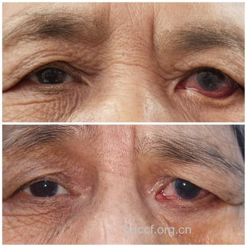 眼睑外翻有哪些症状表现