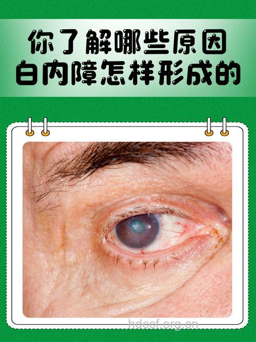 盘点后发性白内障的三个症状