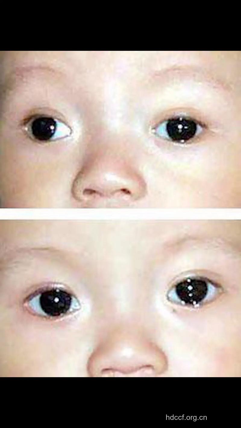 儿童斜视会有哪些早期征兆