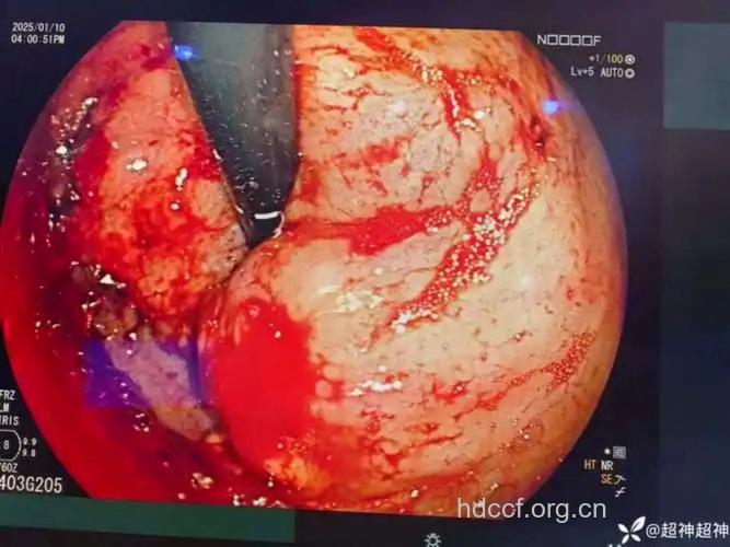 吃柿子惹出胃出血