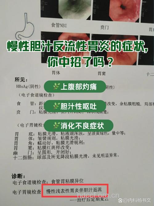 胆汁反流性胃炎的常见症状