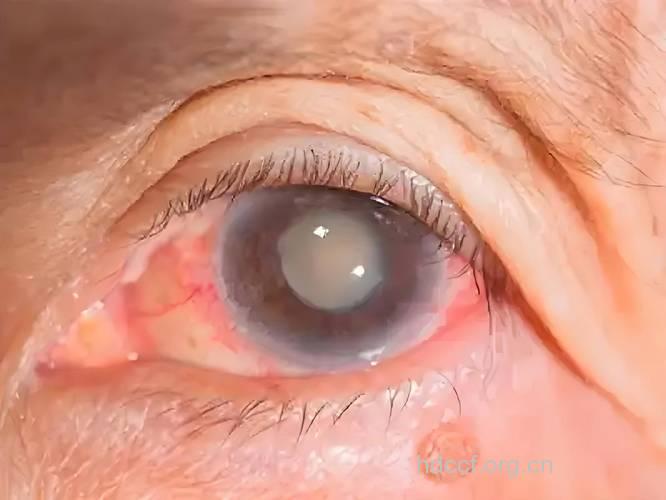 急性白内障症状有哪些