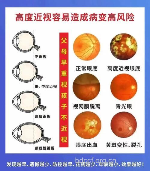 近视眼造成的八大并发症