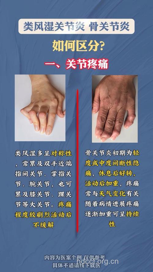 什么是类风湿性关节炎