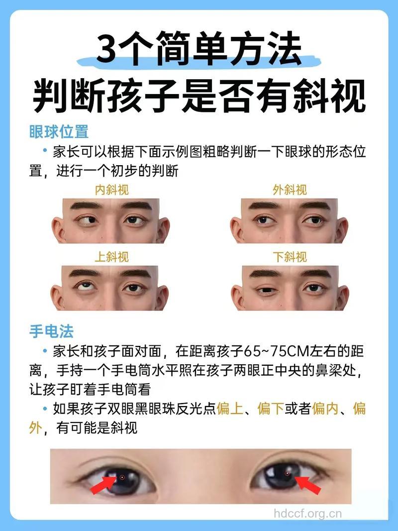 家长应该怎么辨别假性斜视
