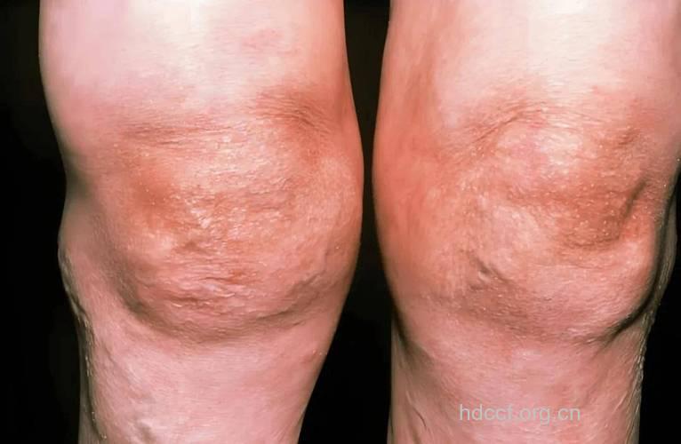 膝关节炎的症状有哪些