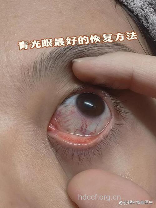 经常揉眼睛会得青光眼吗？