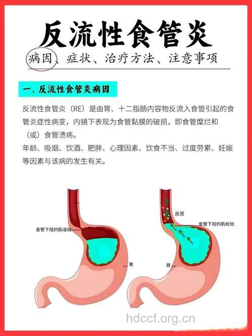 胃食管反流有哪些致病因素