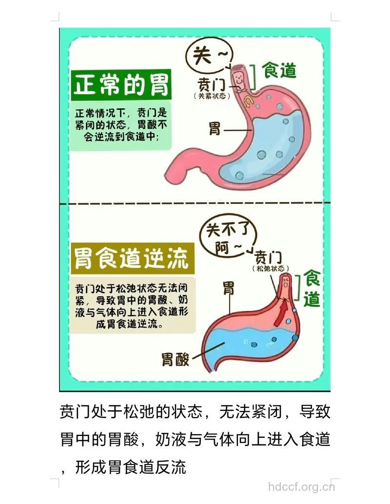 哪些因素导致宝宝胃食管反流