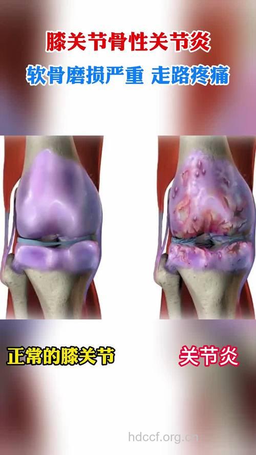 膝关节炎病变过程是怎样的