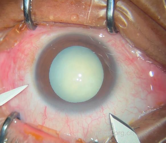 得了白内障就一定要动手术吗？