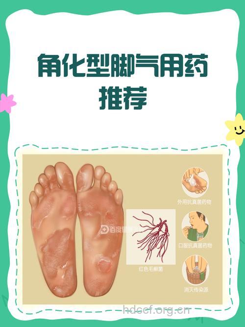 有脚气怎么办 治疗脚气的小偏方推荐