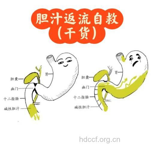 怎么防治胆汁反流方法