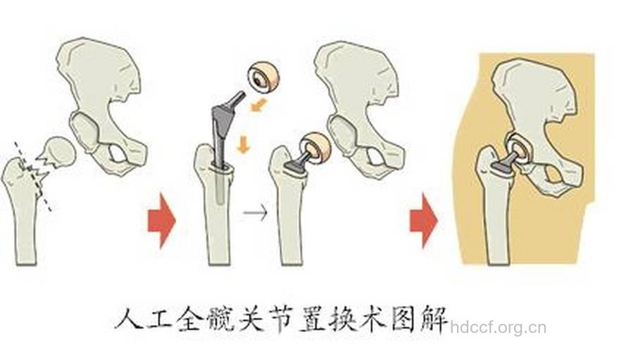 老年人骨关节炎不容忽视关节置换术