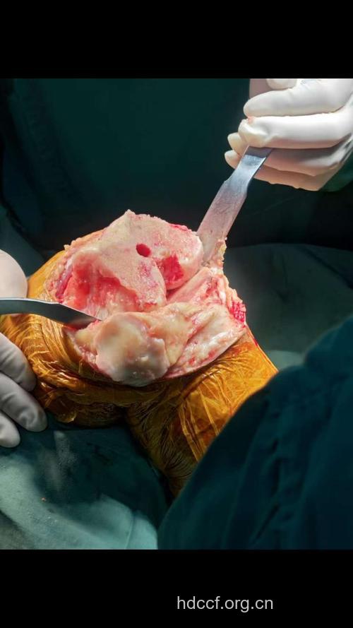 晚期关节炎患者最好做关节置换术