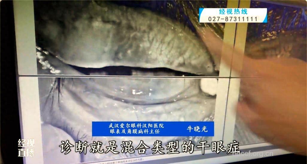 常吹空调会患干眼症