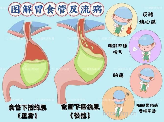 全面了解胃食管返流